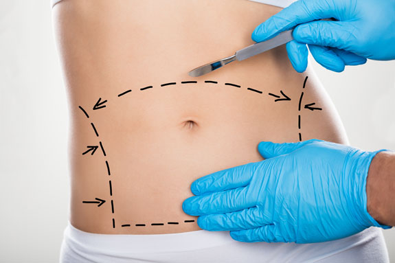 Abdominoplastik