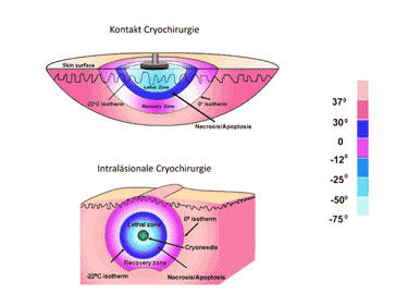 Cryotherapie