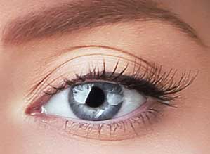 Blepharoplastik